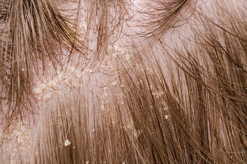 女性の抜け毛は病院の何科を受診すべき？！皮膚科と専門クリニックの違いは？ ふんわり美人